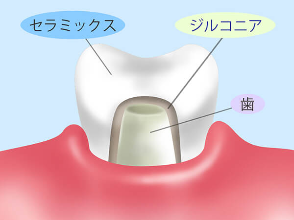 セラミック治療は保険診療と何が違うの・・・？