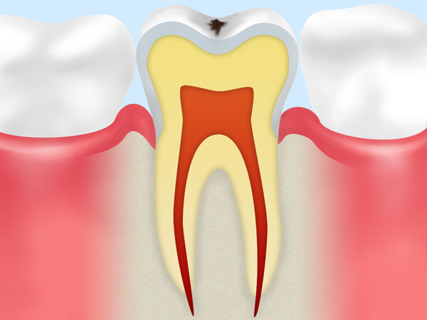 【CO】初期の虫歯