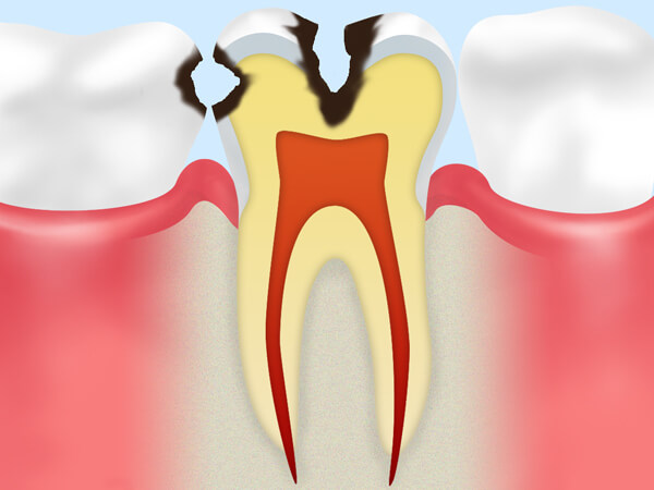 【C2】象牙質の虫歯