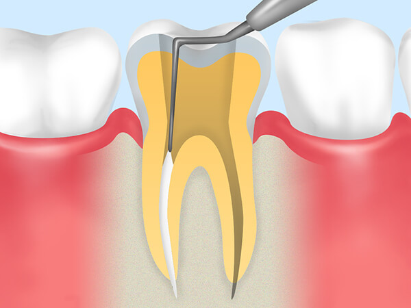 重度の虫歯でも歯を残すための治療です