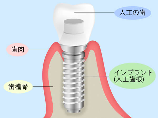 インプラント治療とは