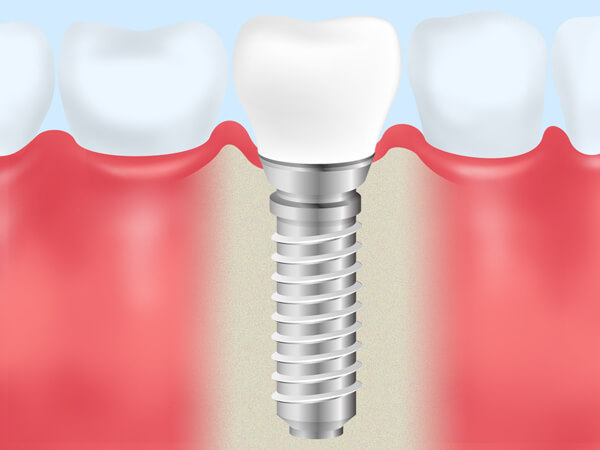 インプラントと入れ歯の比較
