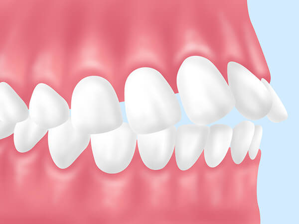 成人矯正をおすすめする歯並び