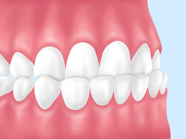 成人矯正をおすすめする歯並び