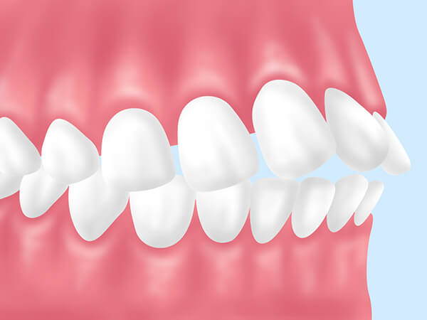 成人矯正をおすすめする歯並び