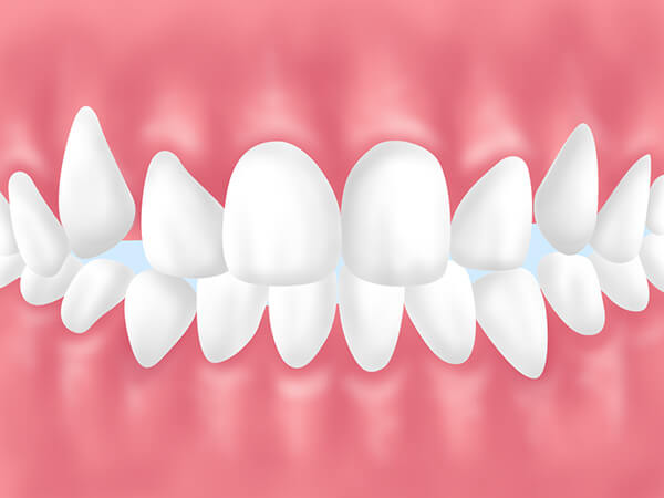 成人矯正をおすすめする歯並び