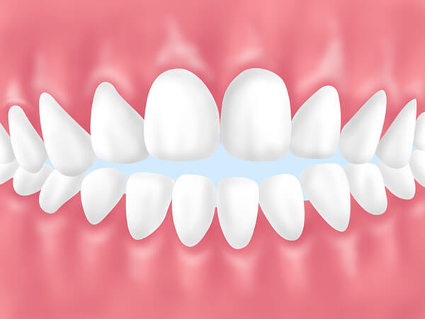 成人矯正をおすすめする歯並び