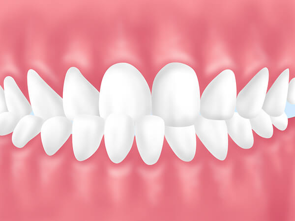 成人矯正をおすすめする歯並び