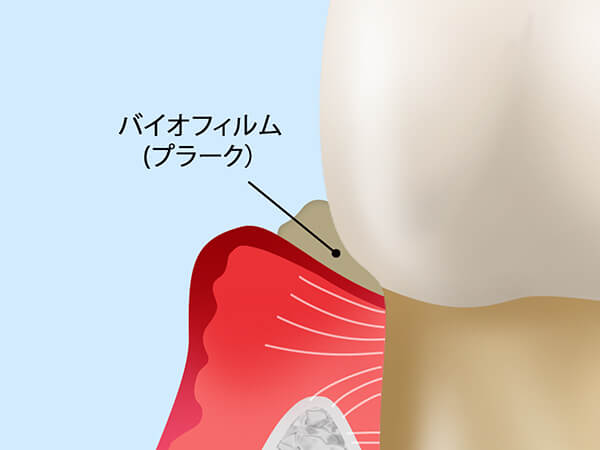 歯周病の進行段階