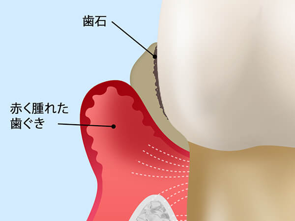 歯周病の進行段階