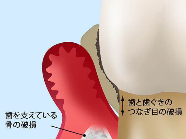 歯周病の進行段階