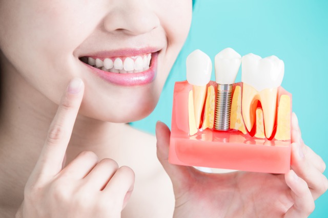 歯を失ってしまった場合の治療法とインプラントのメインテナンスについて